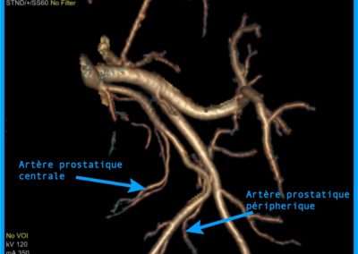 artère prostate 3D