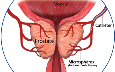 Comment faire dégonfler la prostate naturellement ?