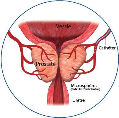 Embolisation de la prostate